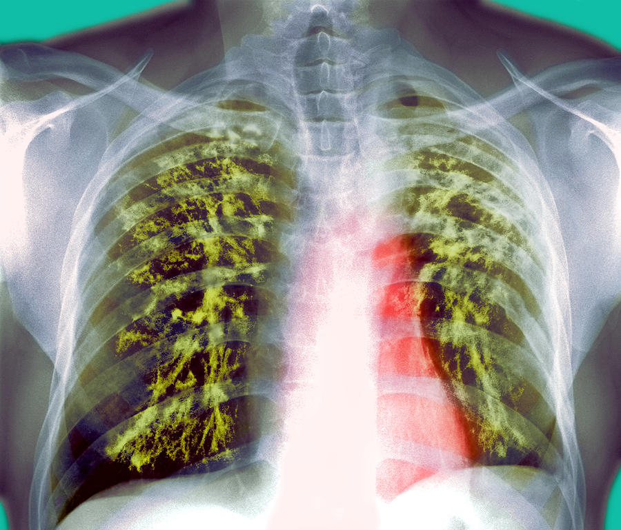 Лёгкие поражённые туберкулёзом