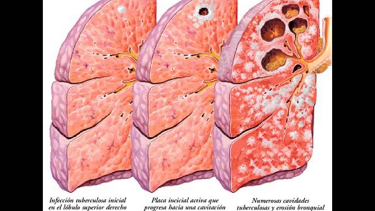 Казеозная пневмония туберкулема